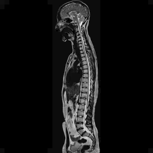 Dlaczego boli Cię kręgosłup, mimo że rezonans jest prawidłowy?