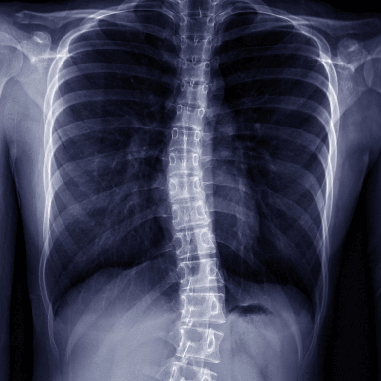 Skolioza to nie tylko skrzywiony kręgosłup. Jak patrzy na nią osteopata?